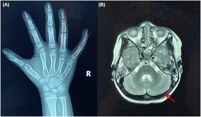 Identification of Two Novel Mutations in COG5 Causing Congenital Disorder of Glycosylation